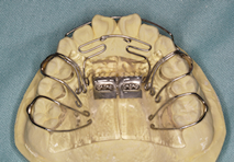 矯正治療 歯並び 歯列矯正